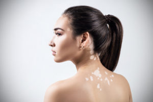 What You Need to Know About Vitiligo: Dermatologist Guide | Dermatologist in Southlake, TX