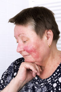 Get-Rid-of-Rosacea--Southlake-Dermatology-Services