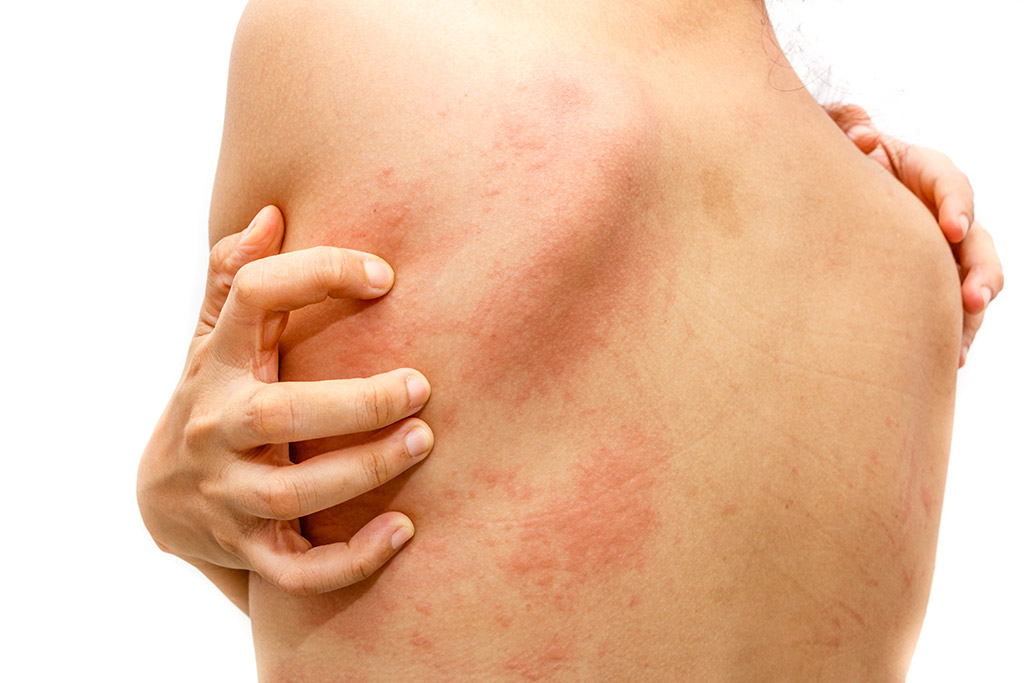 Get Rid Of Skin Hives When Do You Need To Visit A Dermatologist In 