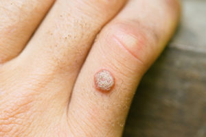 Everything-You-Need-to-Know-About-Those-Unsightly,-Annoying-Warts-_-Dermatologist-in-Southlake,-TX