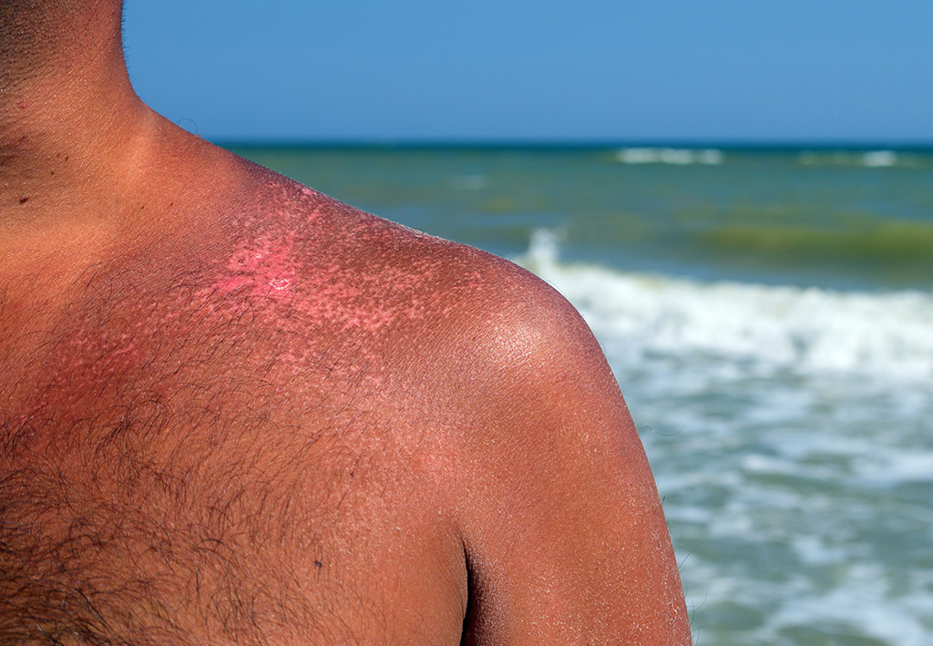 Sunburn-Dos-And-Donts--Tips-From-Your-Dermatologist-_-Fort-Worth,-TX-