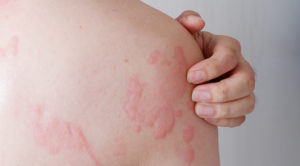 Chronic-Urticaria--How-Your-Dermatologist-Can-Help